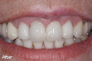 Dental Crown Before After Pictures & Images